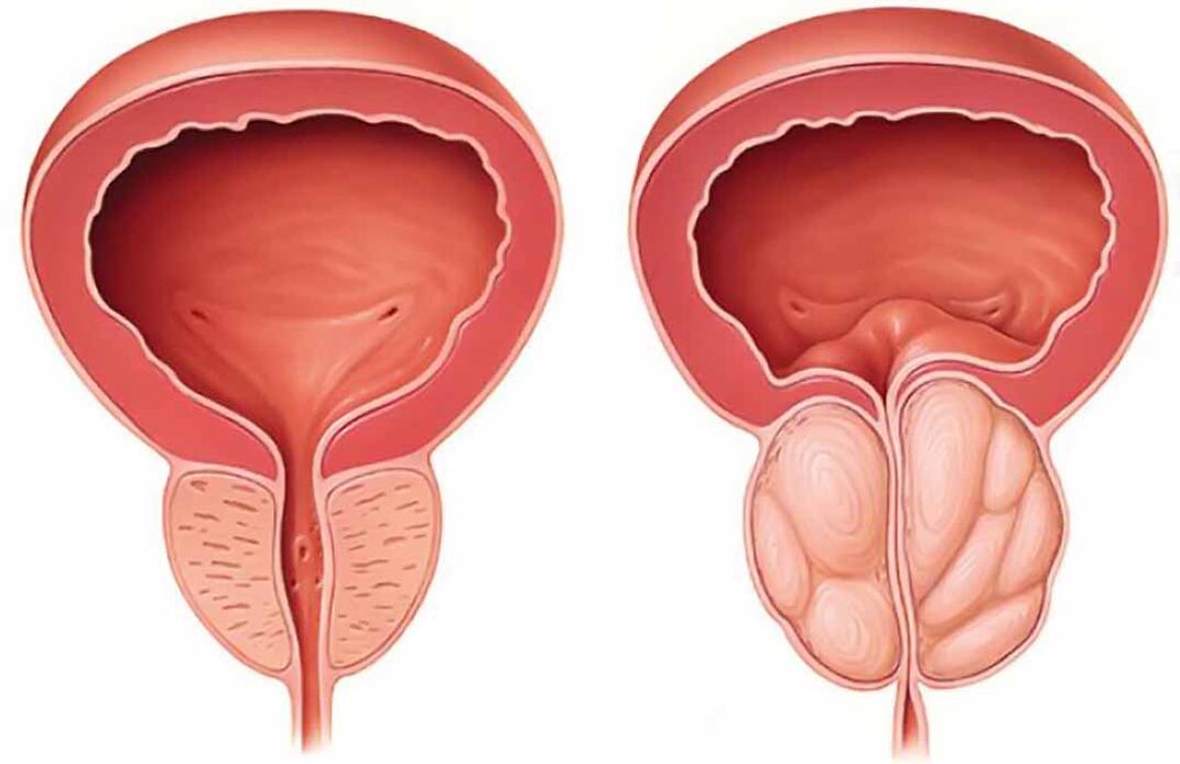 Prostată normală și inflamația glandei prostatei (prostatita cronică)