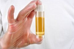 Analiza urinei este una dintre metodele pentru diagnosticarea prostatitei