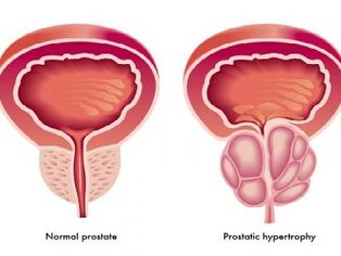 Prostată normală și inflamată