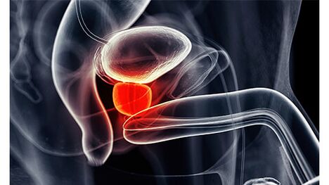 Inflamarea glandei prostatei