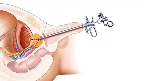 Tratamentul chirurgical al prostatitei